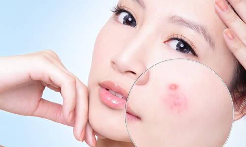 Cách chăm sóc da mặt bị mụn hằng ngày giúp cải thiện tình trạng làn da nhanh chóng