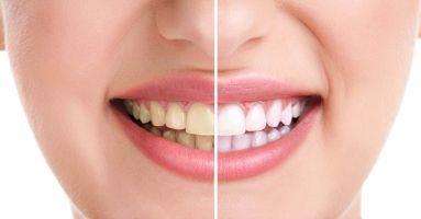 nước vo gạo - thần dược giúp bạn sở hữu hàm răng trắng sáng