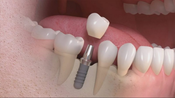 đà nẵng, phòng khám, sức khỏe, top 10 địa chỉ trồng răng implant đà nẵng uy tín nhất