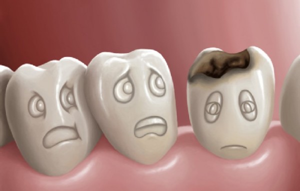 sức khỏe răng miệng, cách chữa sâu răng hàm không cần tới nha sĩ