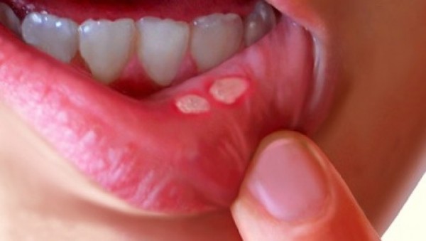 sức khỏe răng miệng, 5 cách chữa nhiệt miệng nhanh và hiệu quả tại nhà