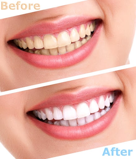 tự tin với top 10 dịch vụ tẩy trắng răng hải phòng