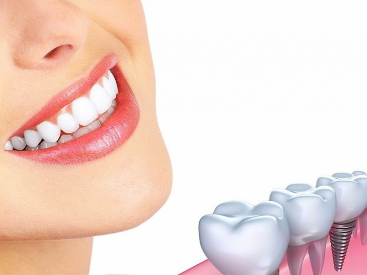 giá trồng răng implant tphcm, nên trồng răng implant ở đâu, phòng khám, sức khỏe, tphcm, điểm qua top 10 địa chỉ trồng răng implant tại tphcm uy tín