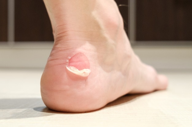Mẹo ngăn phồng rộp chân khi đi bộ đường dài