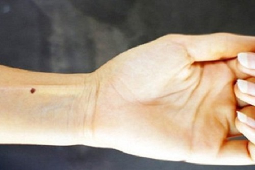 Nốt ruồi ở cổ tay trái, phải nam – nữ có ý nghĩa gì? Tốt hay xấu?