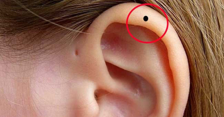 khám phá, nốt ruồi ở cuống tai có ý nghĩa gì? nên tẩy vị trí nốt ruồi ở tai hay không?