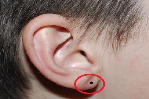 khám phá, nốt ruồi ở cuống tai có ý nghĩa gì? nên tẩy vị trí nốt ruồi ở tai hay không?