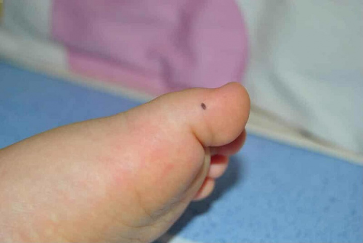 khám phá, nốt ruồi ở ngón chân cái đàn ông, phụ nữ có ý nghĩa gì? bói chuẩn 99%