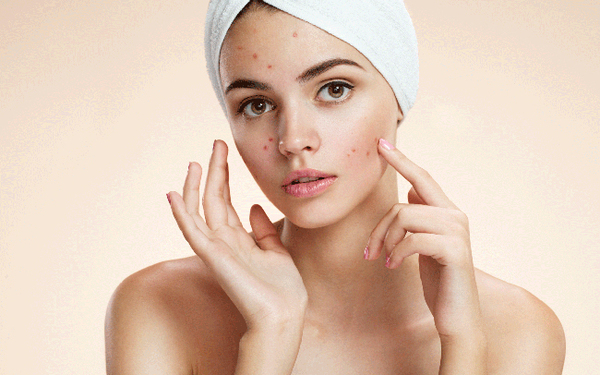 Chăm sóc da sau khi nặn mụn: 9 nguyên tắc cần nắm
