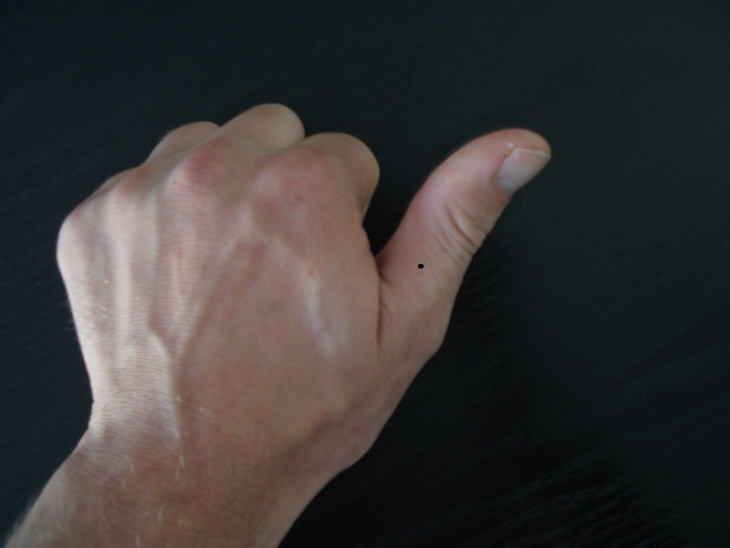 khám phá, ý nghĩa nốt ruồi ở ngón tay cái bên trái & phải nam, nữ