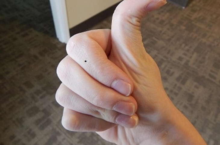 khám phá, ý nghĩa nốt ruồi ở ngón tay cái bên trái & phải nam, nữ