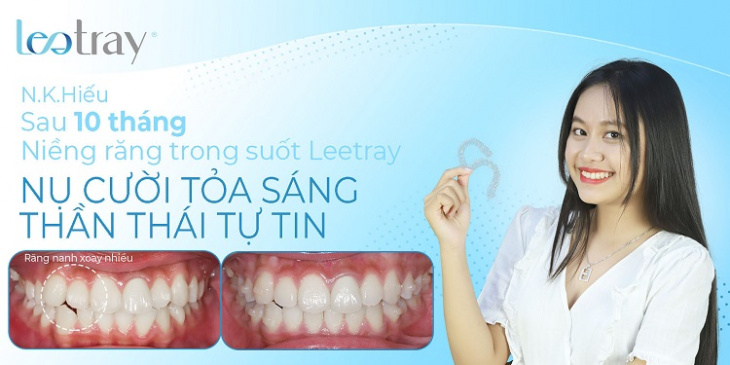 dịch vụ, top 10 địa điểm niềng răng cần thơ đảm bảo an toàn, chất lượng