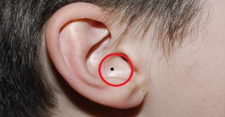 Nốt ruồi trong lỗ tai có ý nghĩa gì? Giàu sang hay nghèo khổ?