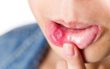 Bị nhiệt miệng thường xuyên và cách điều trị nhanh hiệu quả