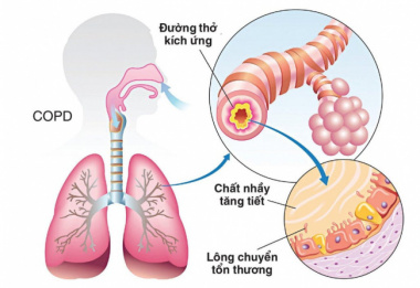 COPD – Tập thể dục có tác động như thế nào với căn bệnh này?