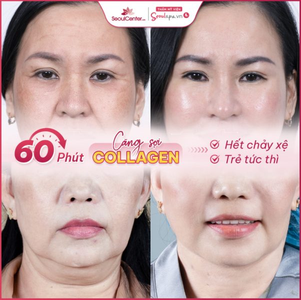 Top 5 địa chỉ căng chỉ collagen trẻ hóa da mặt uy tín tại Tp.HCM, Khám Phá, Trải Nghiệm
