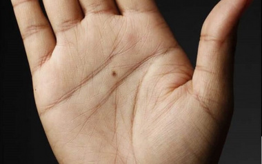 Nốt ruồi đỏ ở tay mang ý nghĩa gì? Có nên tẩy xóa không?