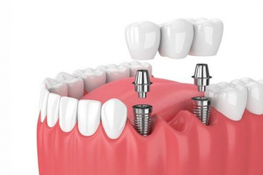 Trồng răng implant giá bao nhiêu và quy trình trồng răng chuẩn nhất 