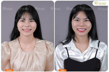 Top 7 Địa chỉ bọc răng sứ thẩm mỹ tốt nhất tại quận Thanh Xuân, Hà Nội