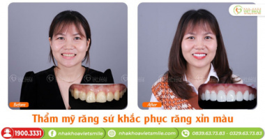 Top 5 địa chỉ bọc răng sứ tốt nhất Quận Cầu Giấy, Hà Nội