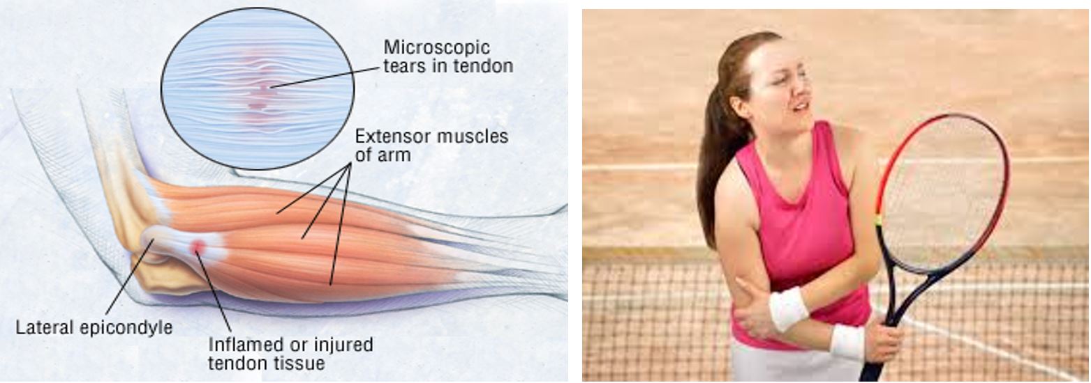 hội chứng tennis elbow - cách điều trị và phòng ngừa