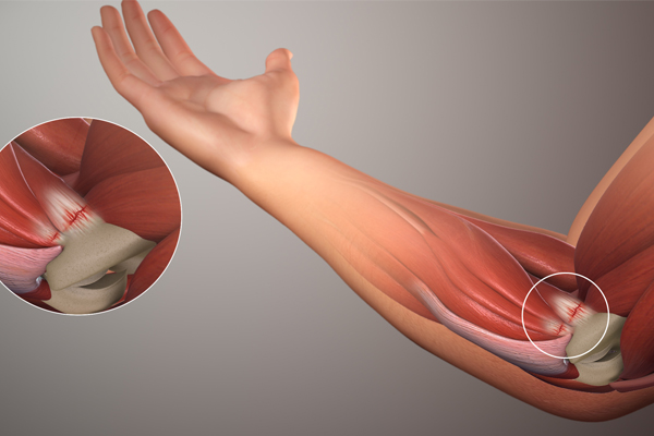 hội chứng tennis elbow - cách điều trị và phòng ngừa