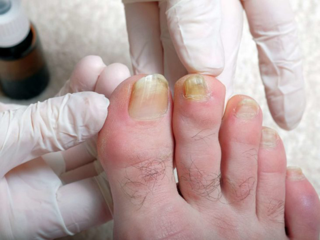 nail đẹp, sơn móng chân bị vàng móng khắc phục bằng cách nào?