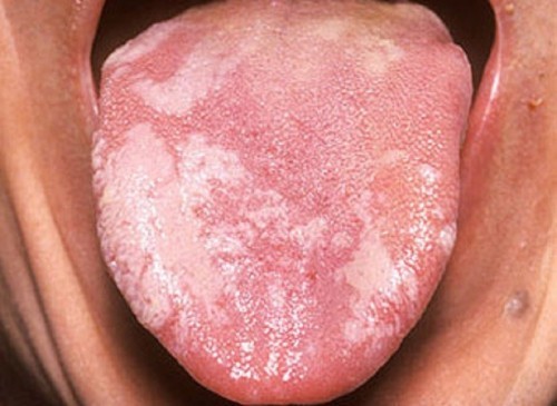 9 màu lưỡi bất thường báo hiệu cơ thể bạn mắc bệnh lý từ lâu