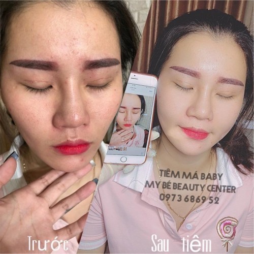 6 Địa chỉ tiêm filler - botox uy tín và chất lượng nhất Bắc Giang