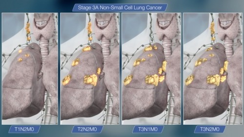8 bệnh ung thư do hút thuốc lá gây ra