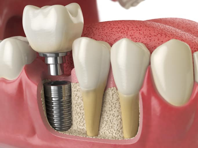 top 4  địa chỉ trồng răng implant tốt nhất tỉnh phú yên