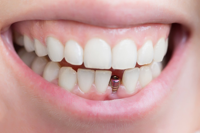 top 5  địa chỉ trồng răng implant tốt nhất tỉnh đắk nông